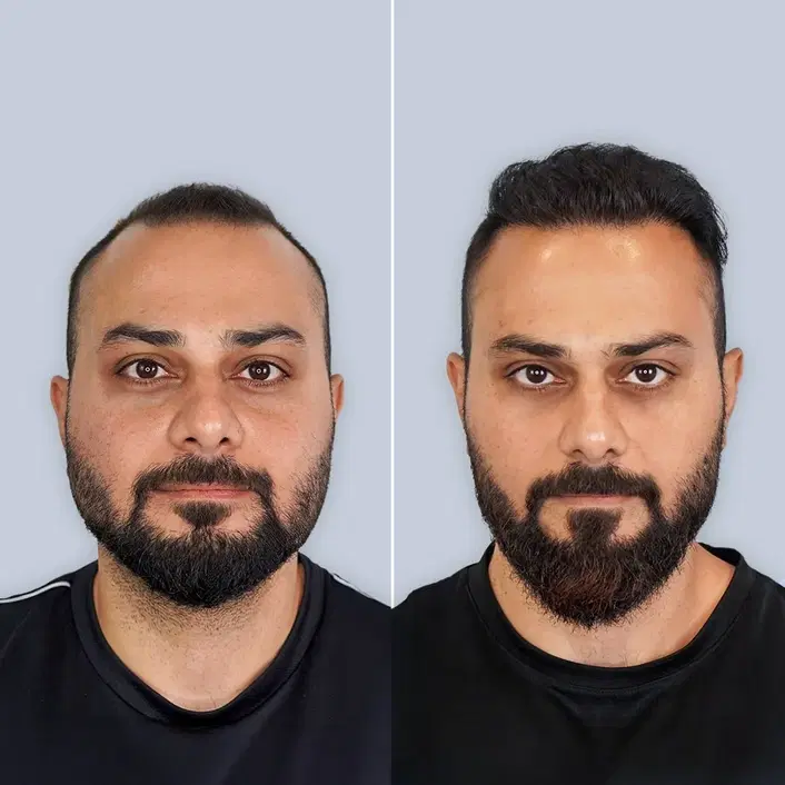 Hair Transplant Before and After Results