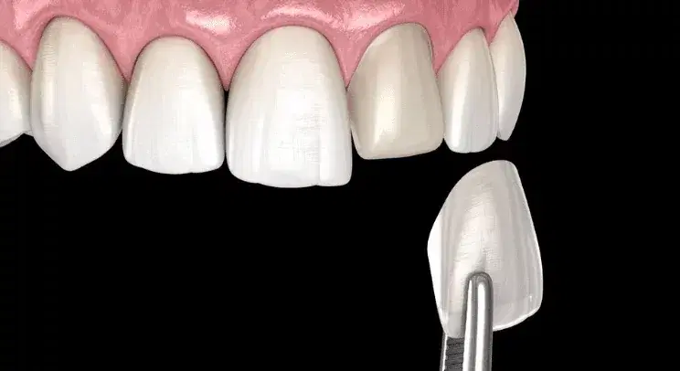 E-Max Veneer in Turkey