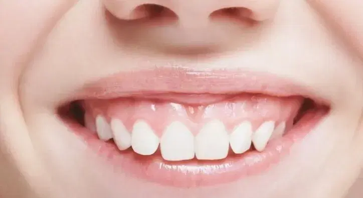 Gummy Smile Makeover in Turkey