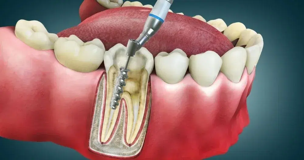 Root Canal Treatment in Turkey
