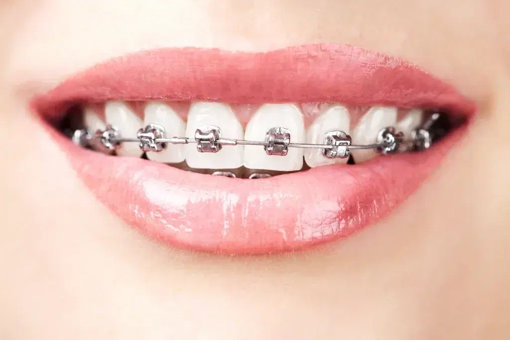 braces in turkey