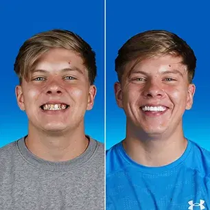 before after