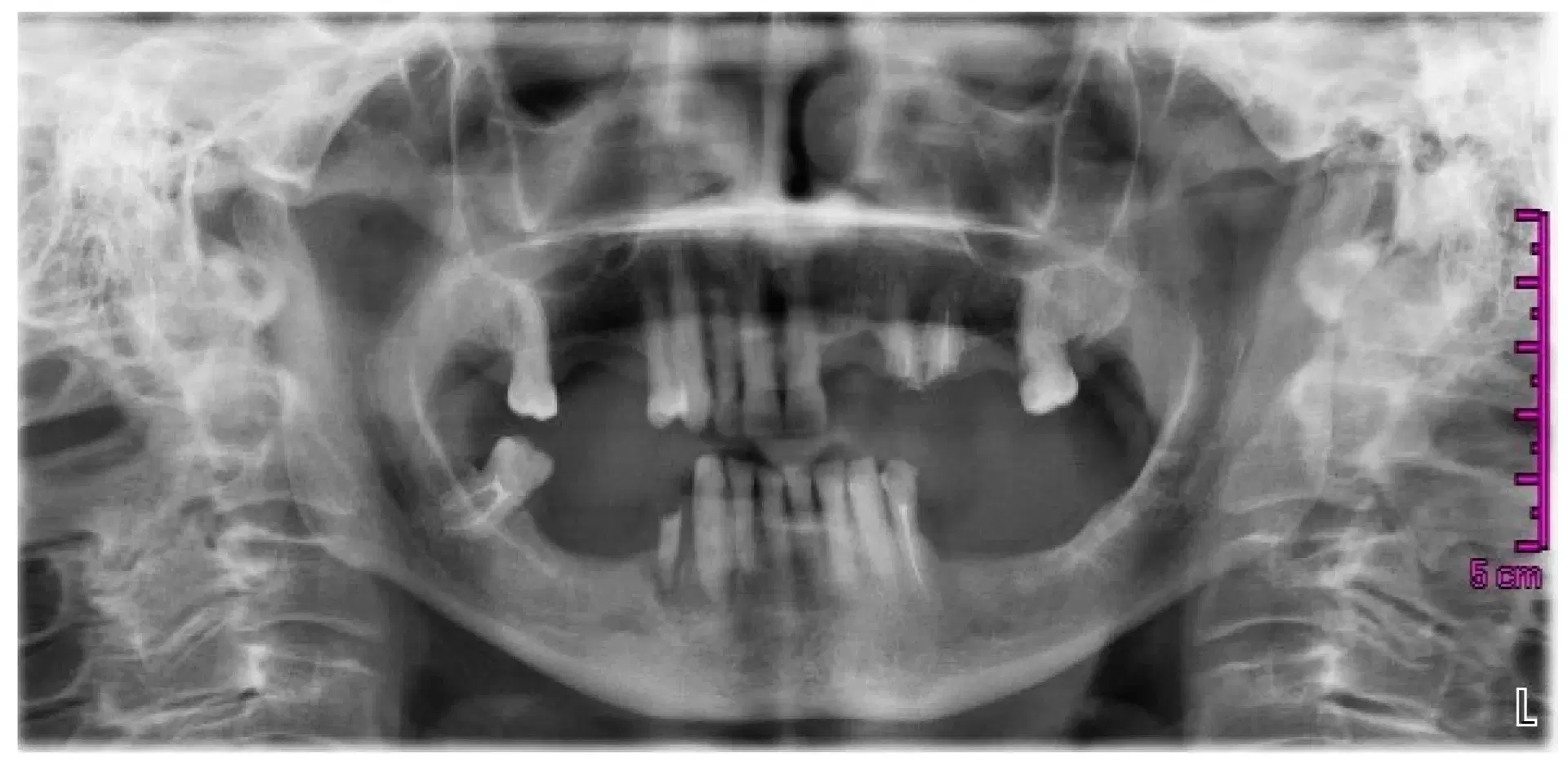 Osteoporosis