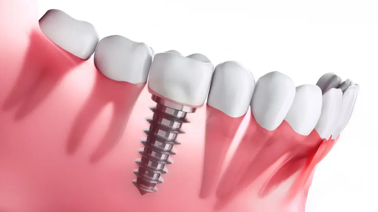 Understanding the Different Types of Dental Implants