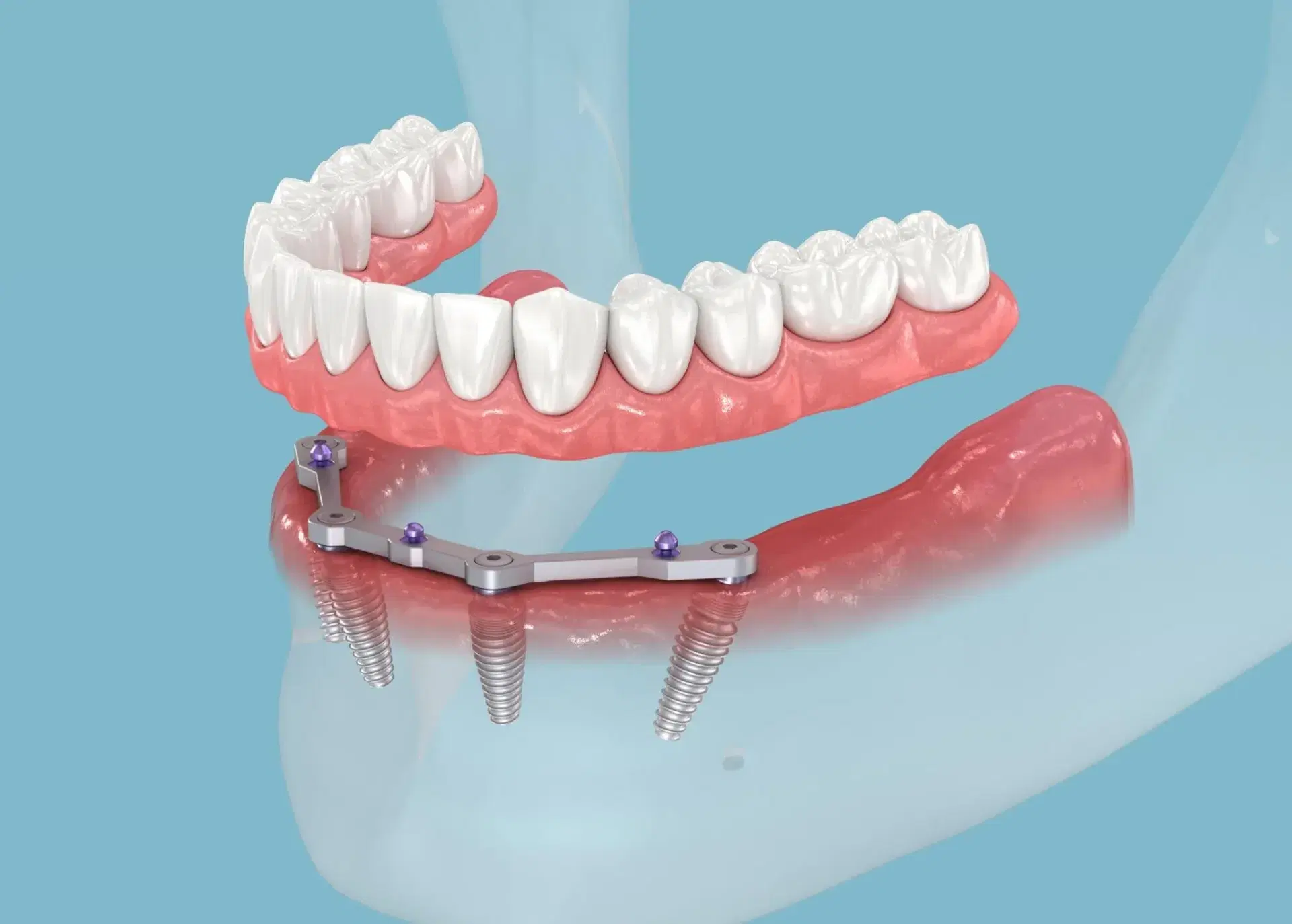All-on-4 Dental Implants