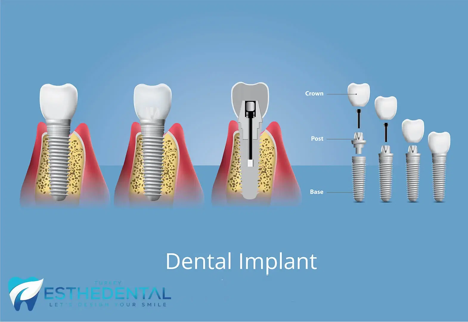 dental implant