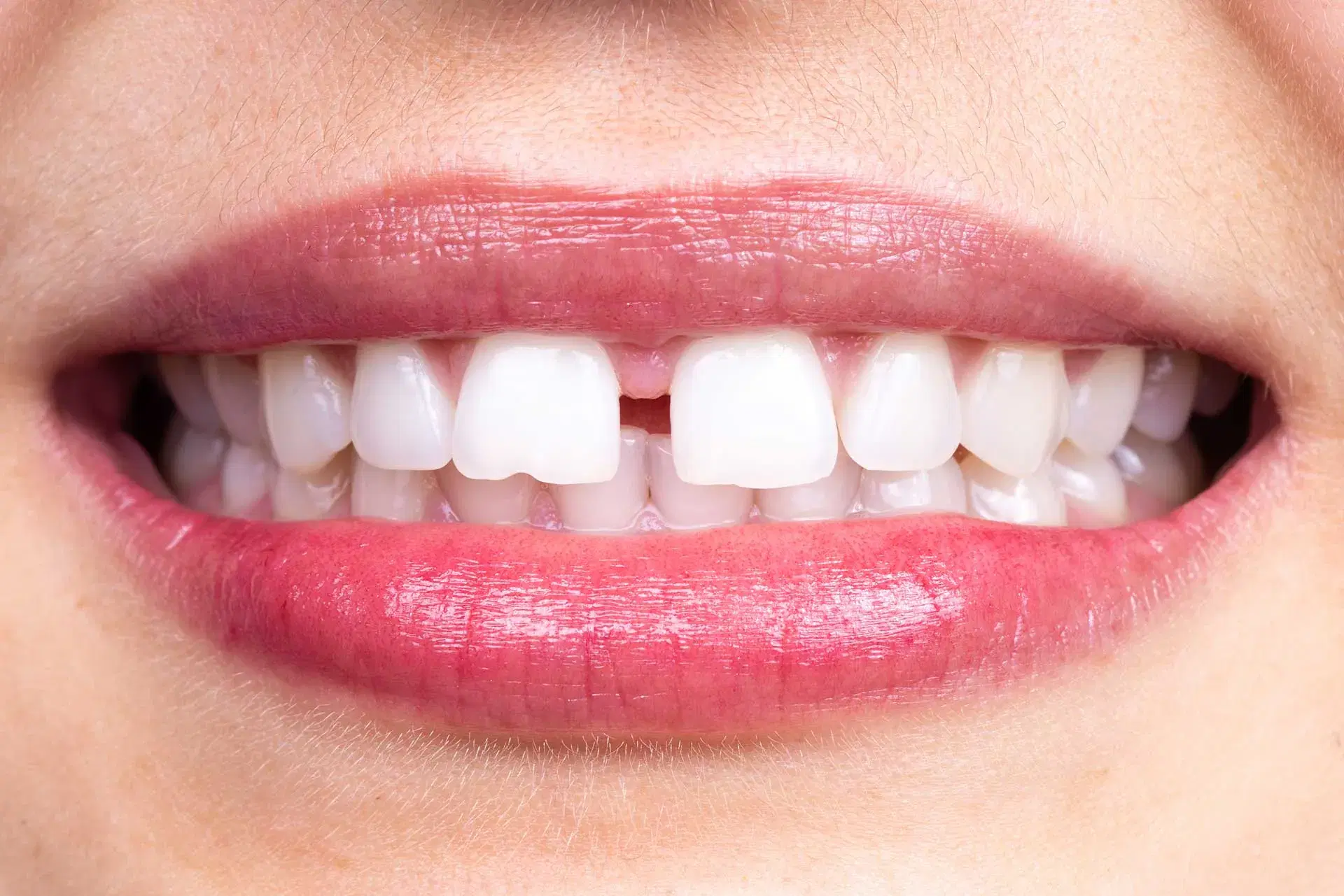 diastema