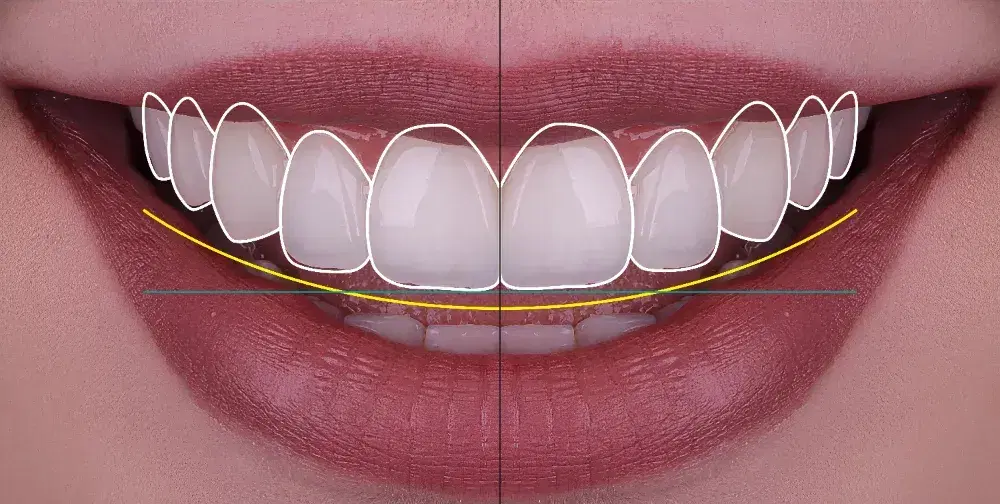 Digital Smile Design Benefits