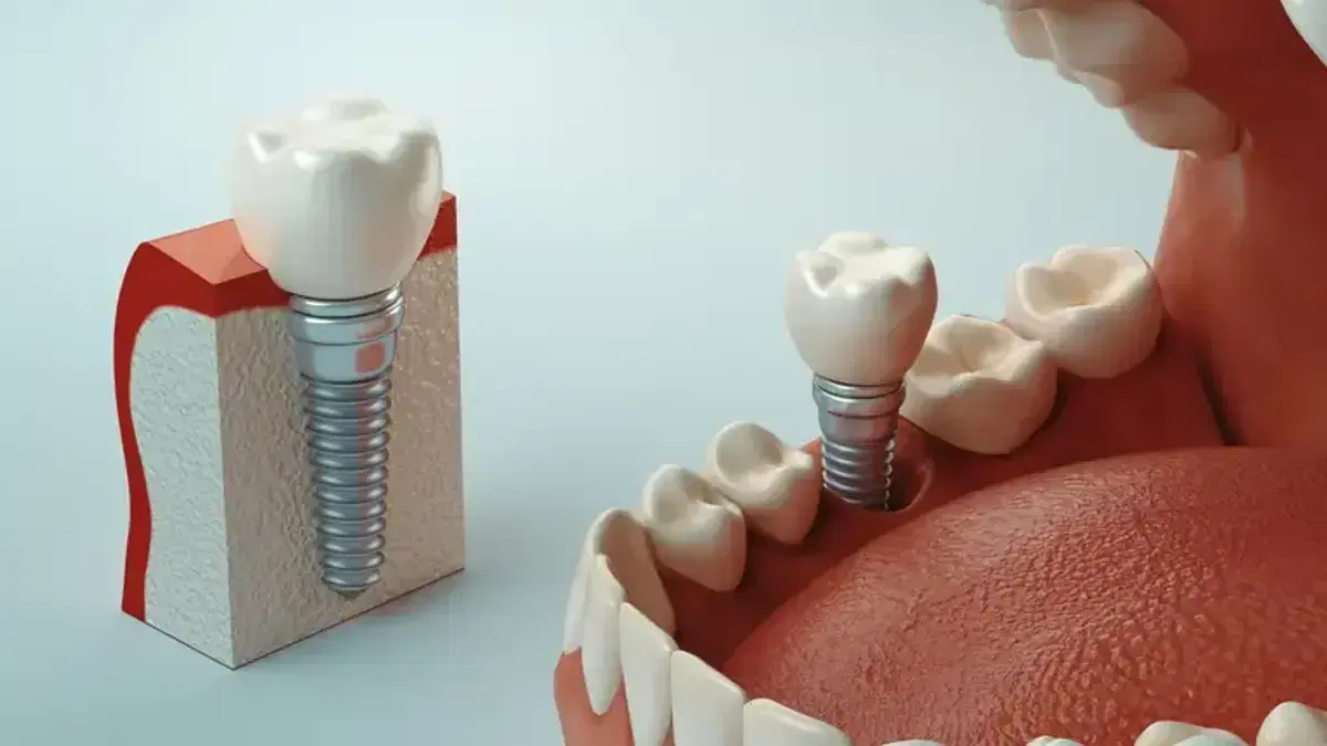 How Much Are Dental Implants in Turkey