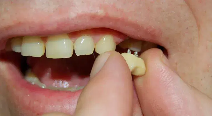 Implant Fall Out