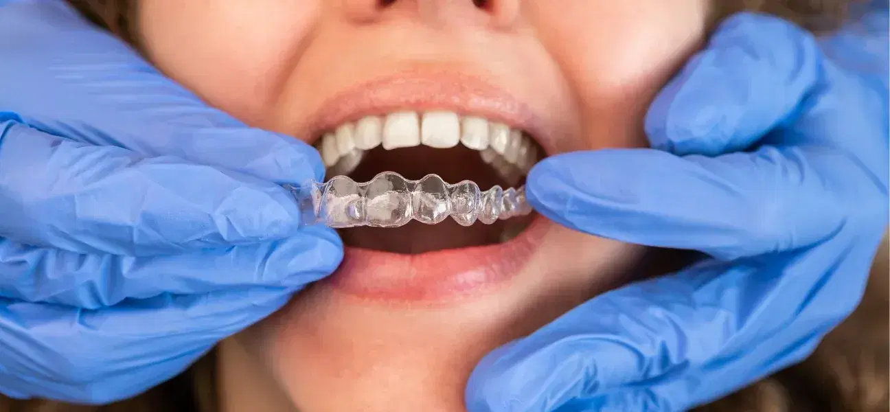 invisalign
