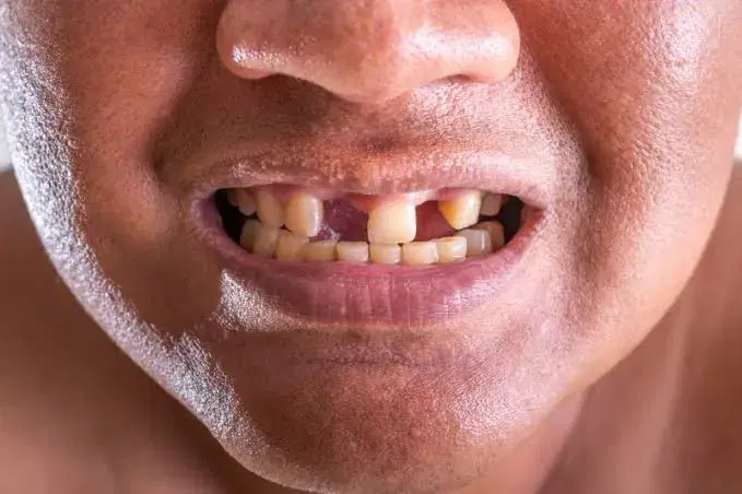 Multiple Missing Teeth