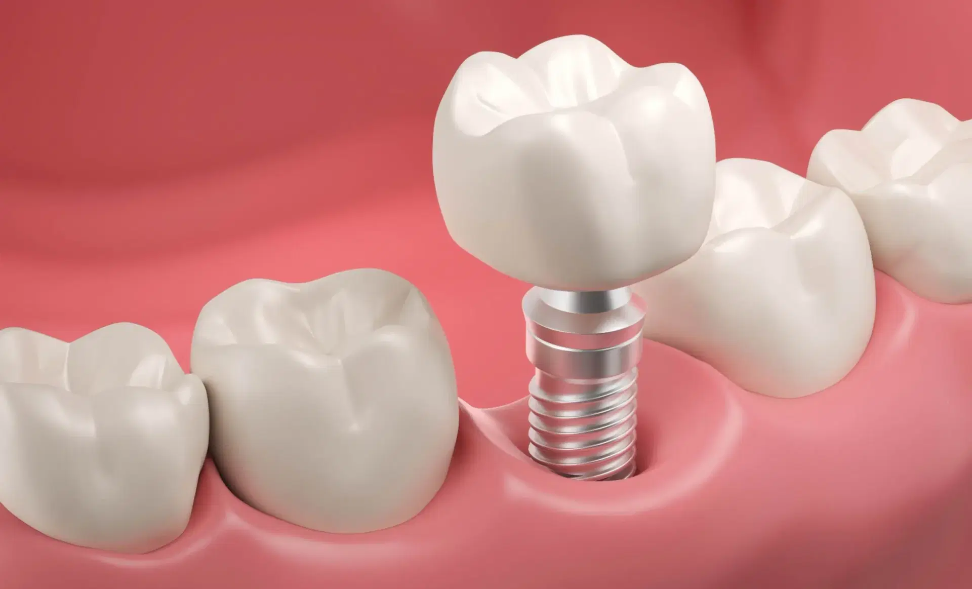 Same Day Tooth Extraction and Implant