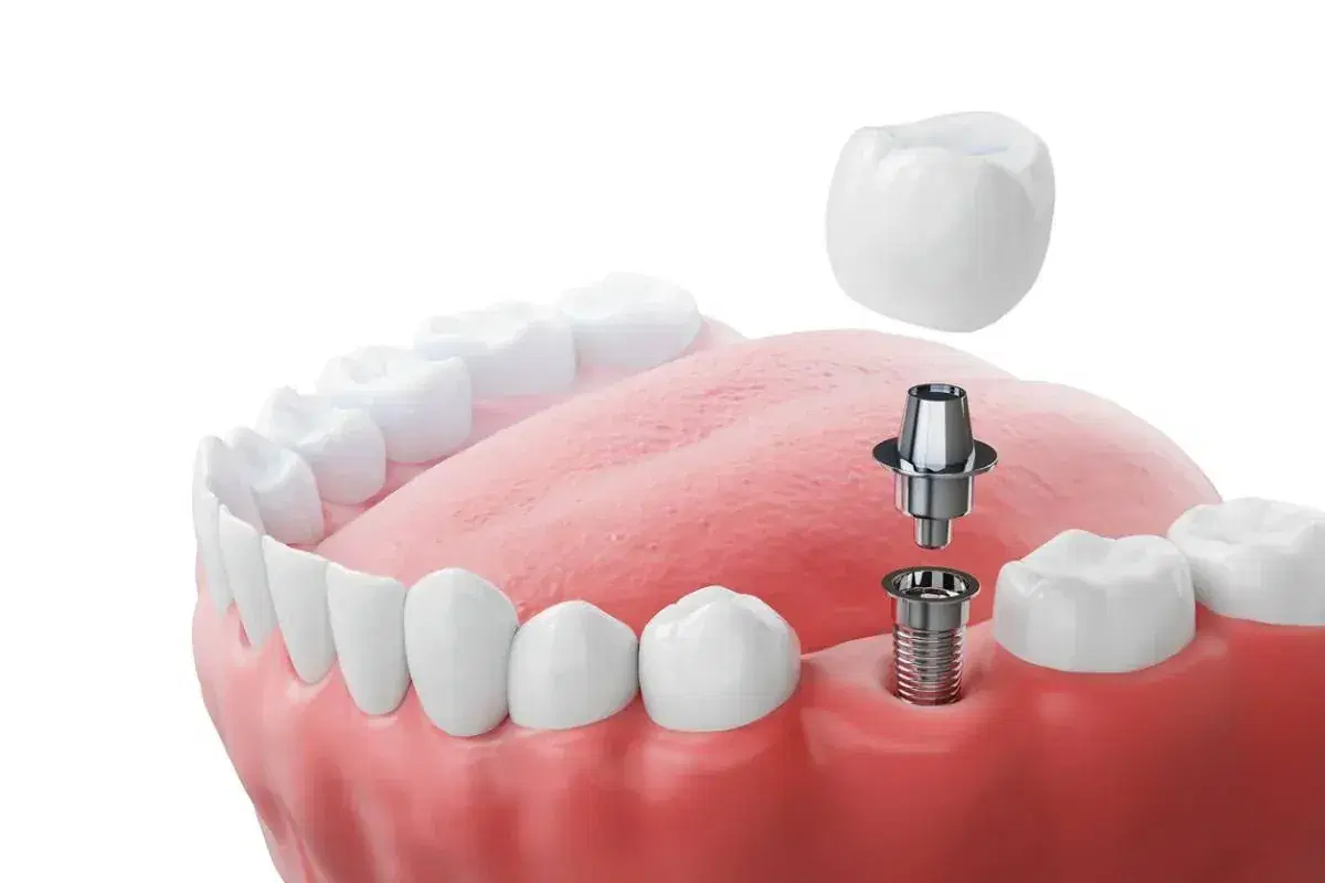 Screwless Dental Implants