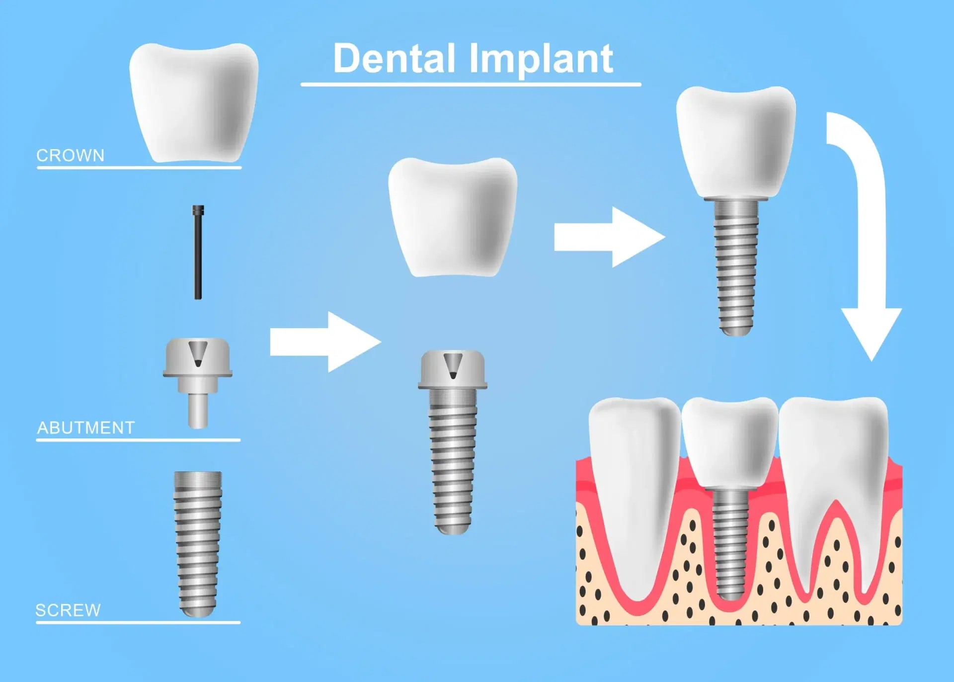 types of dental implants